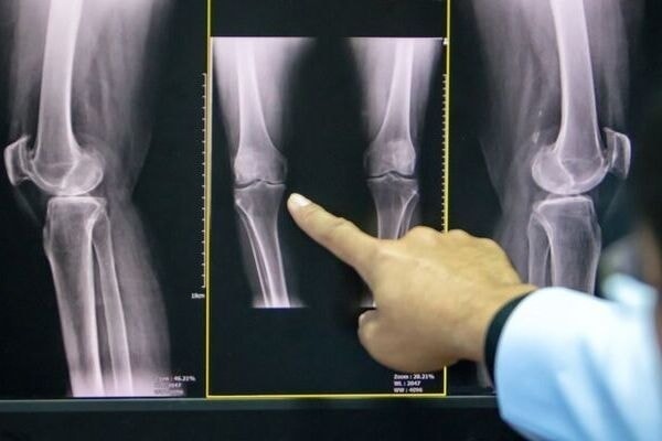 膝関節のレントゲン