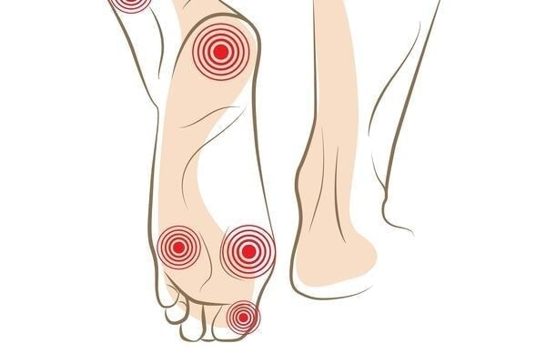 足底筋膜炎